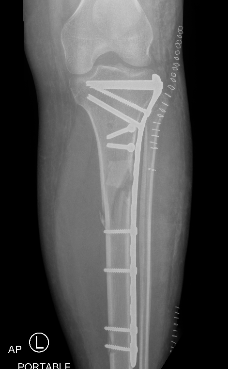 Proximal Tibial Plate